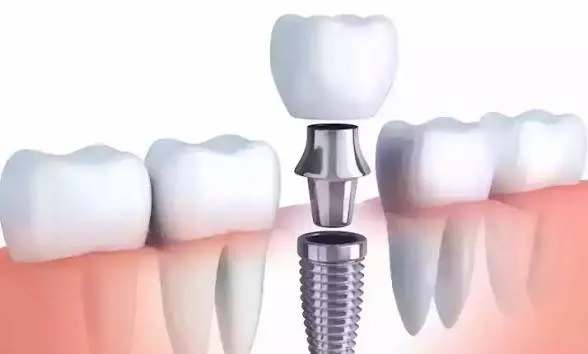 تجربتي مع زراعة الاسنان 