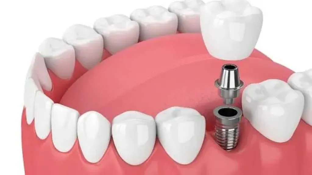دليل جراحة وتجميل الأسنان في مصر: ارخص اسعار زراعة اسنان